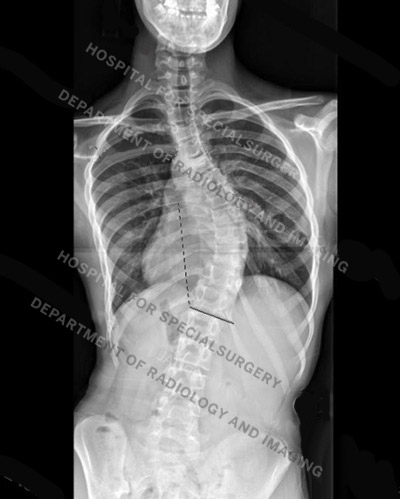 X-ray of a patient with idiopathic scoliosis.
