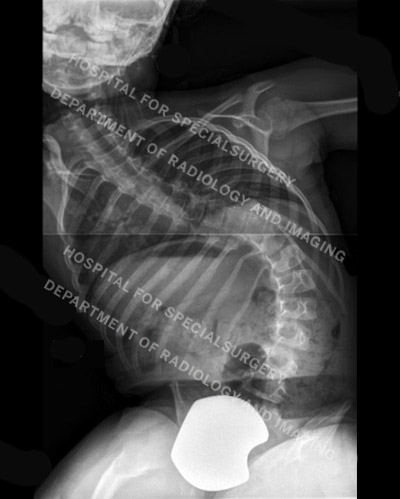 X-ray of patient with neuromuscular scoliosis.