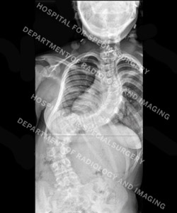 Preoperative anterior X-ray of a patient with neuromuscular scoliosis.