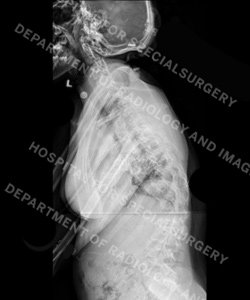 Preoperative lateral X-ray of a patient with neuromuscular scoliosis.