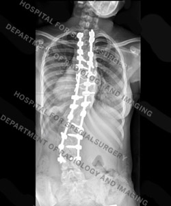 Preoperative back-to-front X-ray view of a patient with neuromuscular scoliosis.