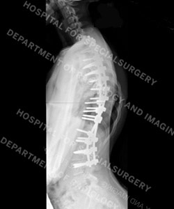 Lateral X-ray of the same patient after surgery.