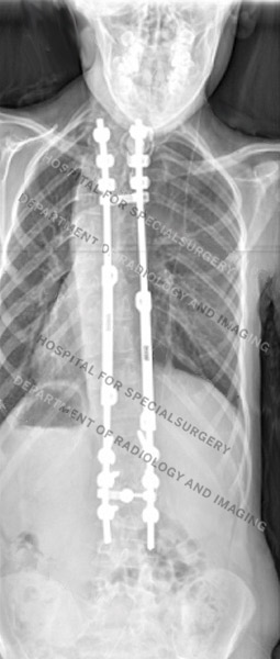 X-ray images of nondystrophic scoliosis after surgery 