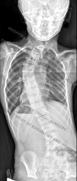 X-ray image of nondystrophic scoliosis