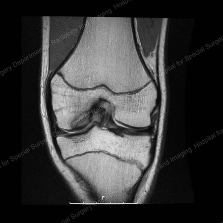 Image showing the presence of osteochondritis dissecans (OCD)