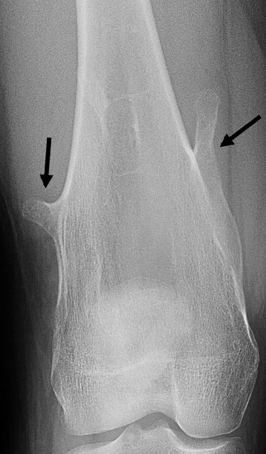 X-ray image of multiple, pedunculated osteochondroma bone tumors on a femur.