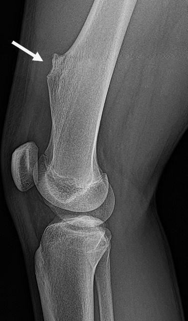 A single, sessile osteochondroma bone tumor on the femur.