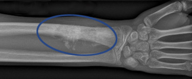 X-ray image of wrist and forearm showing osteosarcoma in the radius bone.