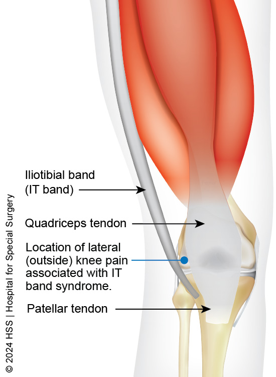 outer knee pain related to IT band syndrome