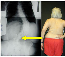 Image: Patient X-ray and photo showing pain pattern in adult-scoliosis and concavity of lumbroscral fractional curve.