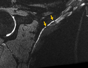 long thoracic