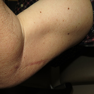 Photo of brachialis muscle atrophy due to musculocutaneous neuropathy.