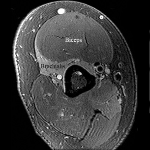 MR neurography image showing denervation of the brachialis muscle with the biceps muscle remaining unaffected.