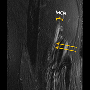 MR neurography image of musculocutaneous neuropathy with hourglass-like constrictions of the brachialis fascicular nerve bundle.