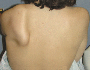 Photo of a person's shoulder showing muscle atrophy and scapular winging.