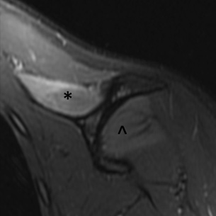 MR neurography image showing Parsonage-Turner syndrome denervation of supraspinatus and infrapinatus muscles.