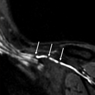 MR neurography image of Parsonage-Turner syndrome patient showing intrinic, hourglass-like constrictions of superscapular nerve