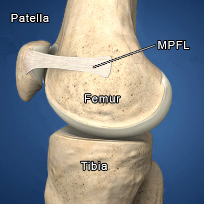 Diagram of patellofemoral joint showing the MPFL.