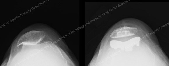 Radiographs of before and after patellofemoral joint after a knee replacement from an article about Arthritis in the Knee from Hospital for Special Surgery