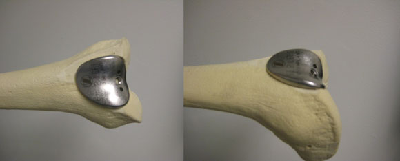 image of a patellofemoral knee replacement implant