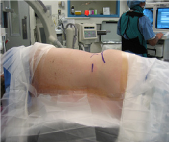 Image of a patient in the operating room ready for surgery.