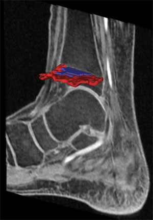 Image showing a 3D model of a growth plate injury obtained from an MRI