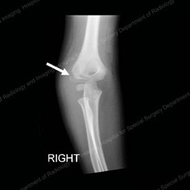 X-ray image showing anterior view of a lateral condyle fracture.