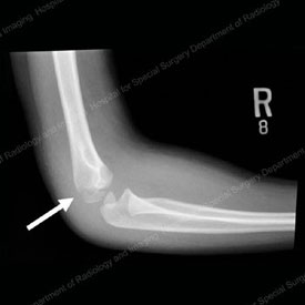 X-ray image showing lateral view of a lateral condyle fracture.