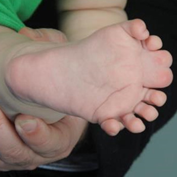 Complex synpolydactyly of the foot.