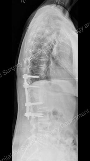 X-ray showing the corrected vertebrae after spinal fusion
