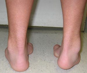 posterior view of the same patient demonstrating Bilateral Cavovarus Feet from an article about pediatric foot deformities
