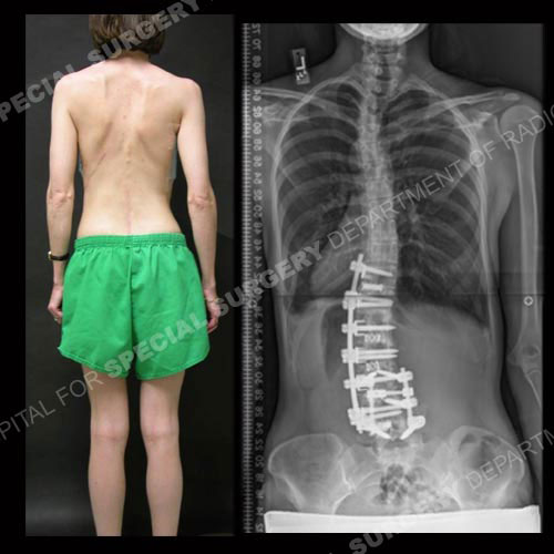 The same patient after anterior/posterior fusion and instrumentation (photo and X-ray).