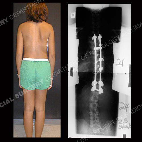 The same patient after posterior fusion and instrumentation (photo and X-ray).