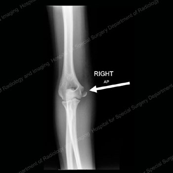 X-ray image showing anterior view of a medial epicondyle fracture.