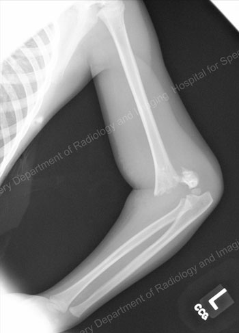 X-ray image showing supracondylar humerus fracture.