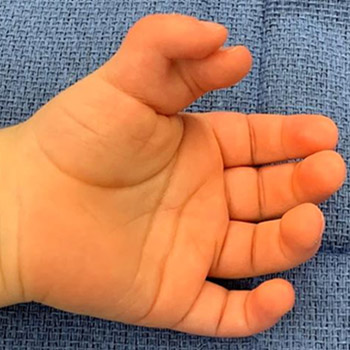A preaxial polydactyly with two partially conjoined thumbs.