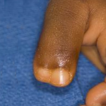 A preaxial polydactyly with two completely conjoined thumbs of roughy equal size..
