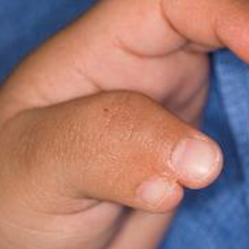 A preaxial polydactyly with two completely conjoined thumbs with one significantly smaller than the other.