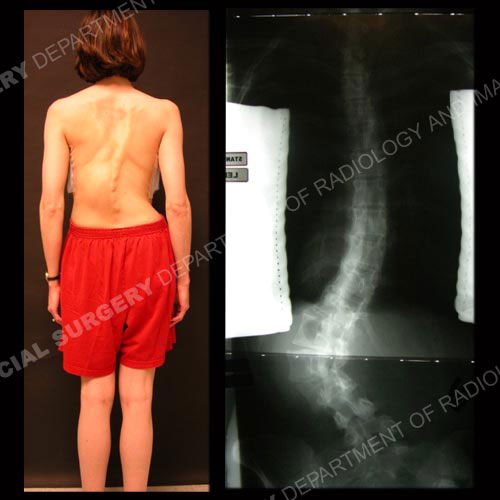 Pre-op images of an adult with lumbar scoliosis (photo and X-ray).
