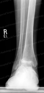 X-ray image of an ankle in the "end stage" of arthritis