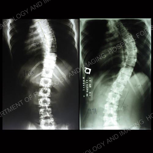 X-rays 1 and 2 of 4: Progression of adult scoliosis from age 14 to age 46.