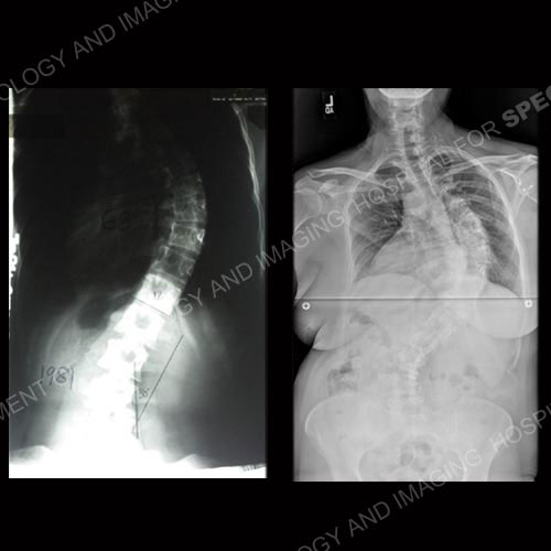 X-rays 3 and 4 of 4: Progression of adult scoliosis from age 14 to age 46.