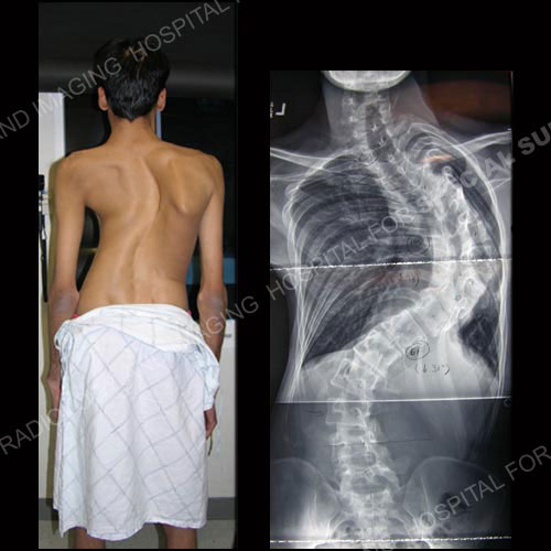 Photo and X-ray of patient with severe curve progression and restrictive pulmonary disease.