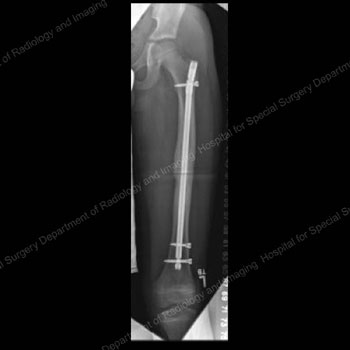 X-ray image showing a rigid intramedullary nail in place.