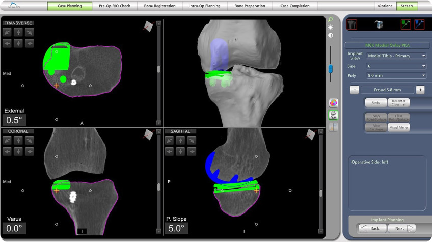 Computerirzed preplanning for a robotic partial knee replacement .