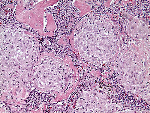 Microscope image of a non-caseating granuloma in lymph node.