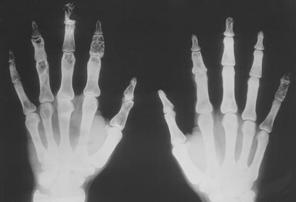 X-ray showing osseous sarcoid in hand and finger bones.