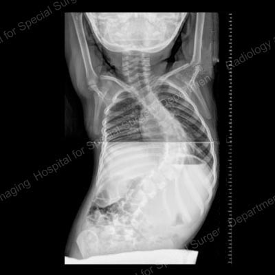 X-ray of a juvenile with scoliosis.