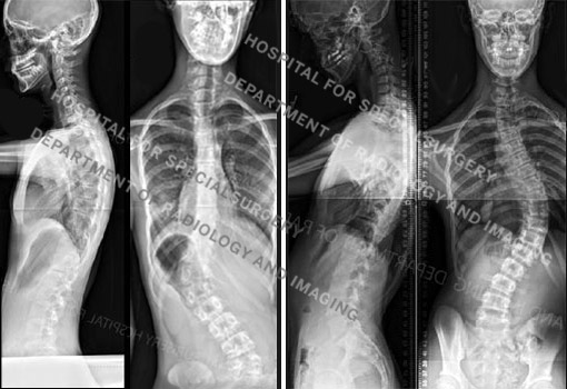 X-ray images of idiopatchic scoliosis.