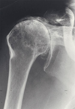 Xray showing both arthritis and big tear of rotator cuff tendon